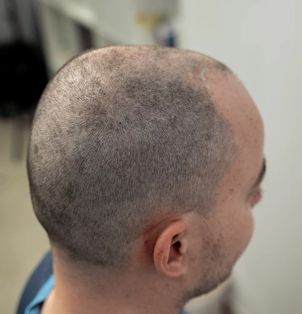 antes-micropigmentacion-capilar