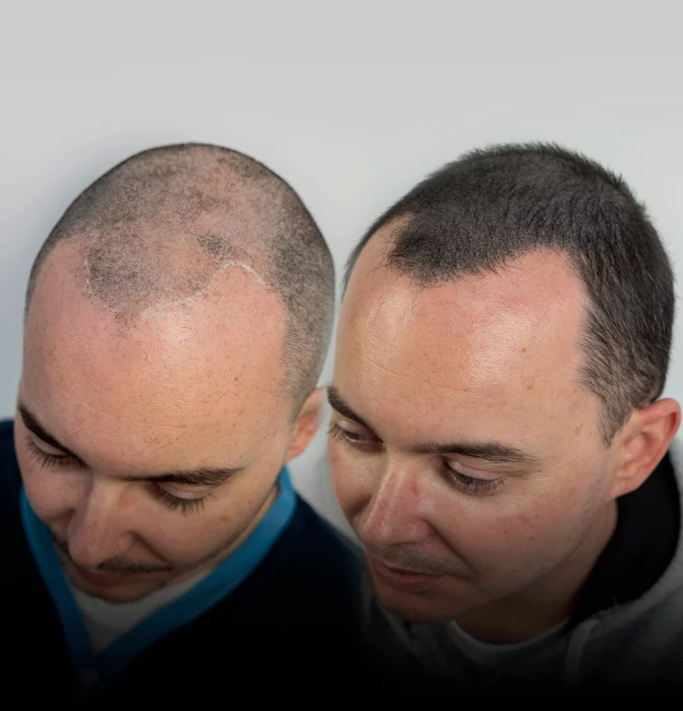 efecto-densidad-micropigmentacion-capilar-murcia