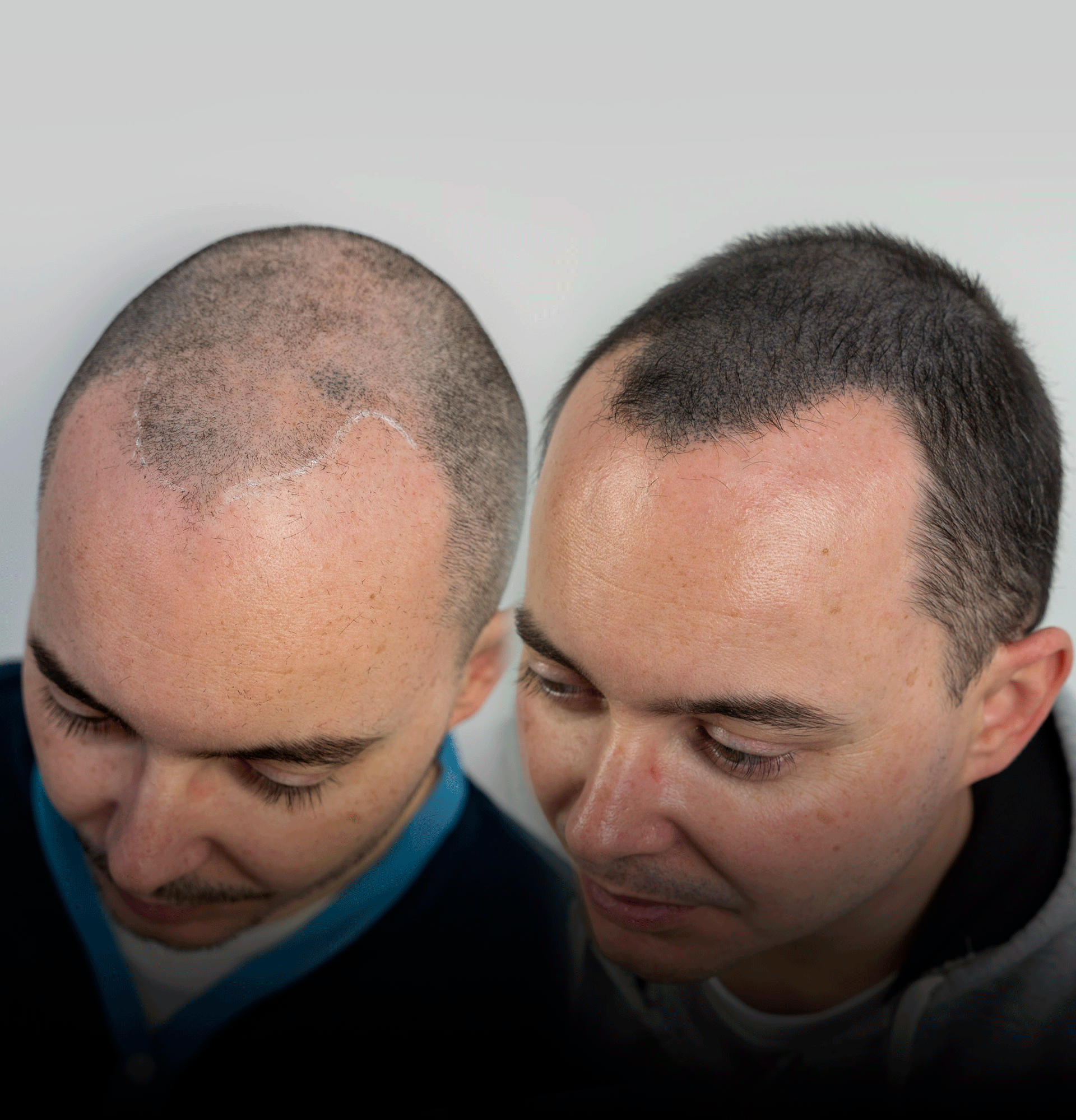 efecto-densidad-micropigmentacion-capilar-murcia