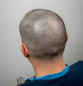 que-saber-antes-hacerte-tratamiento-micropigmentacion-capilar