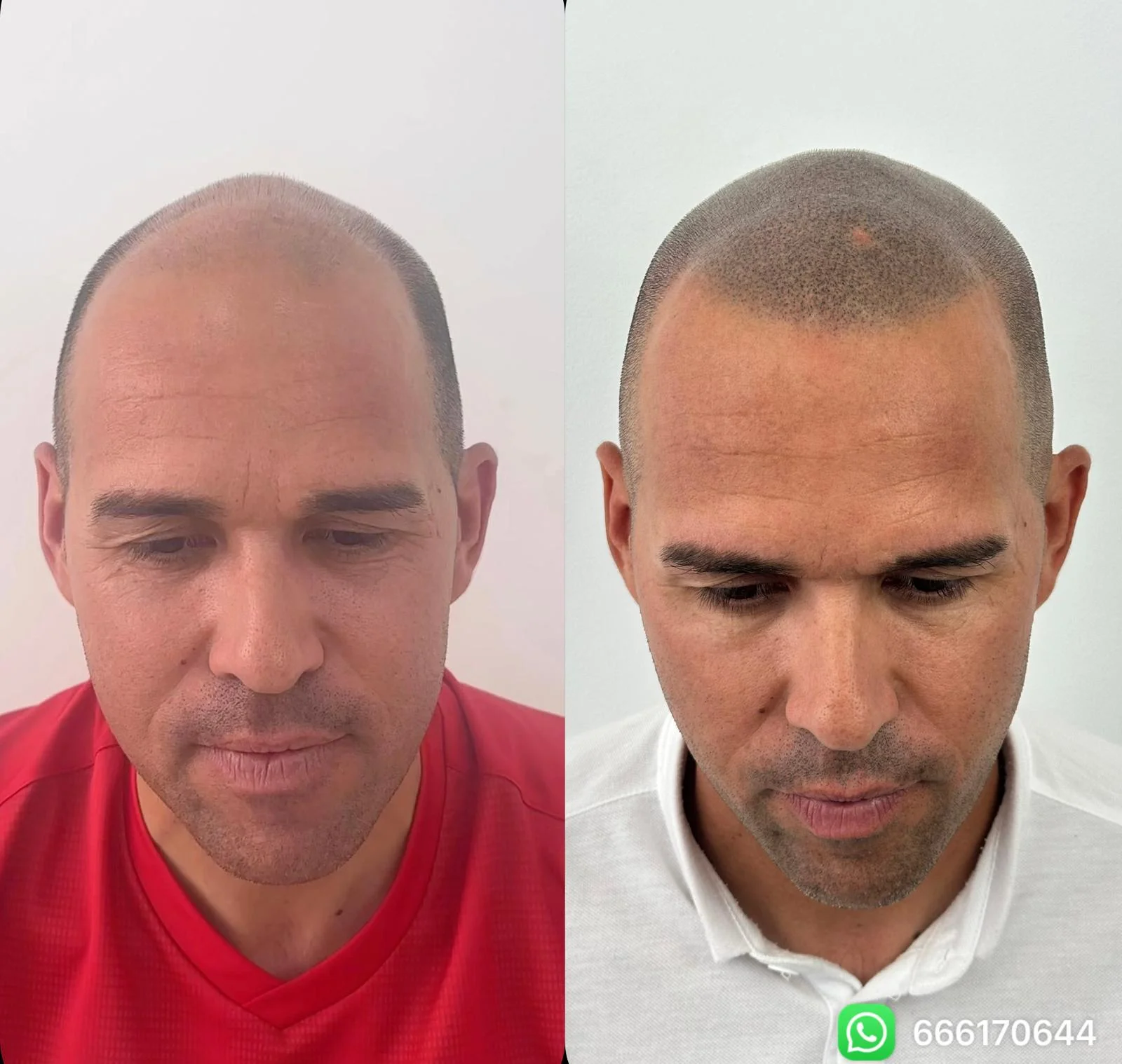 antes-despues-micropigmentacion-efecto-rapado
