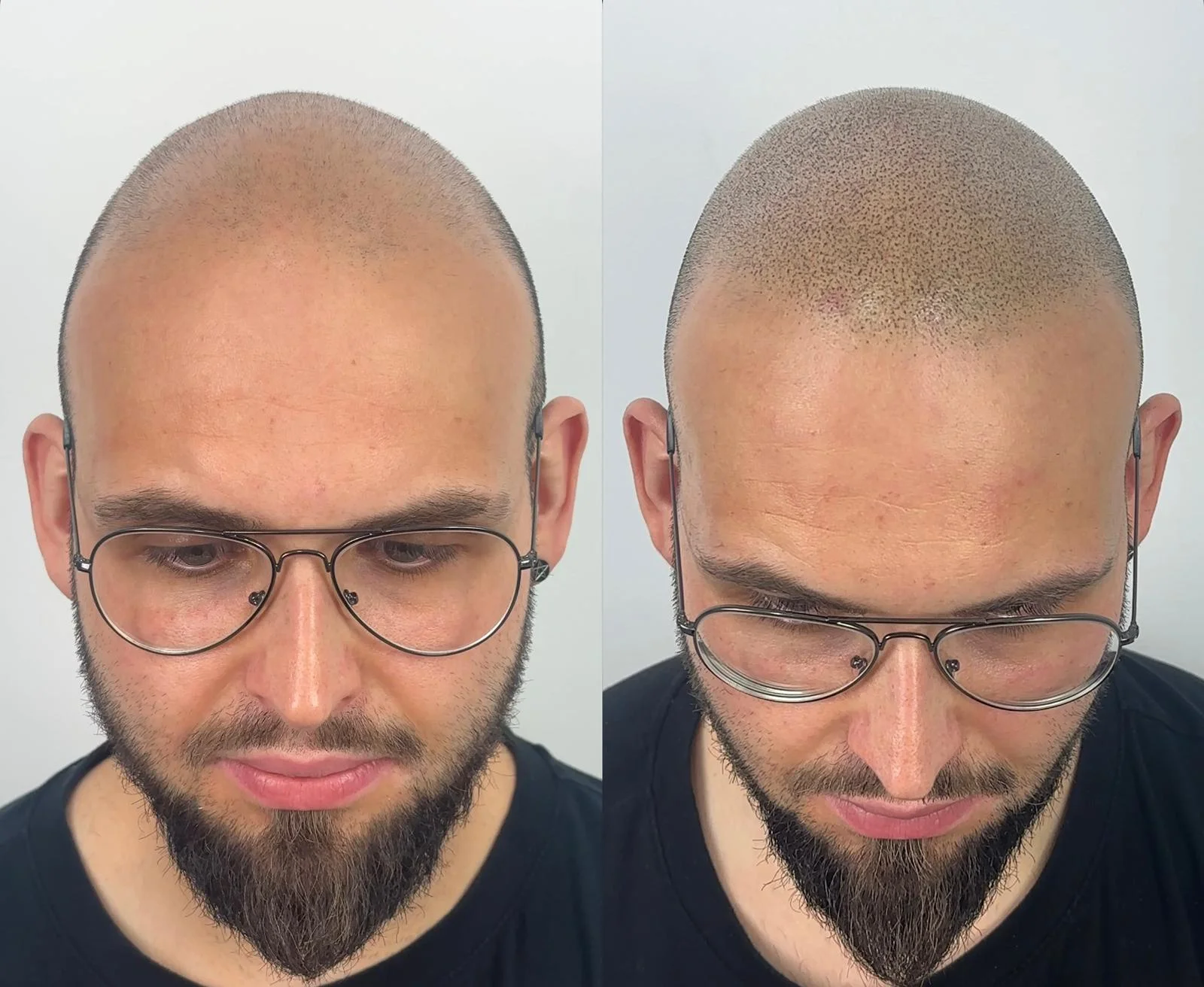 resultados-micropigmentacion-antes-despues
