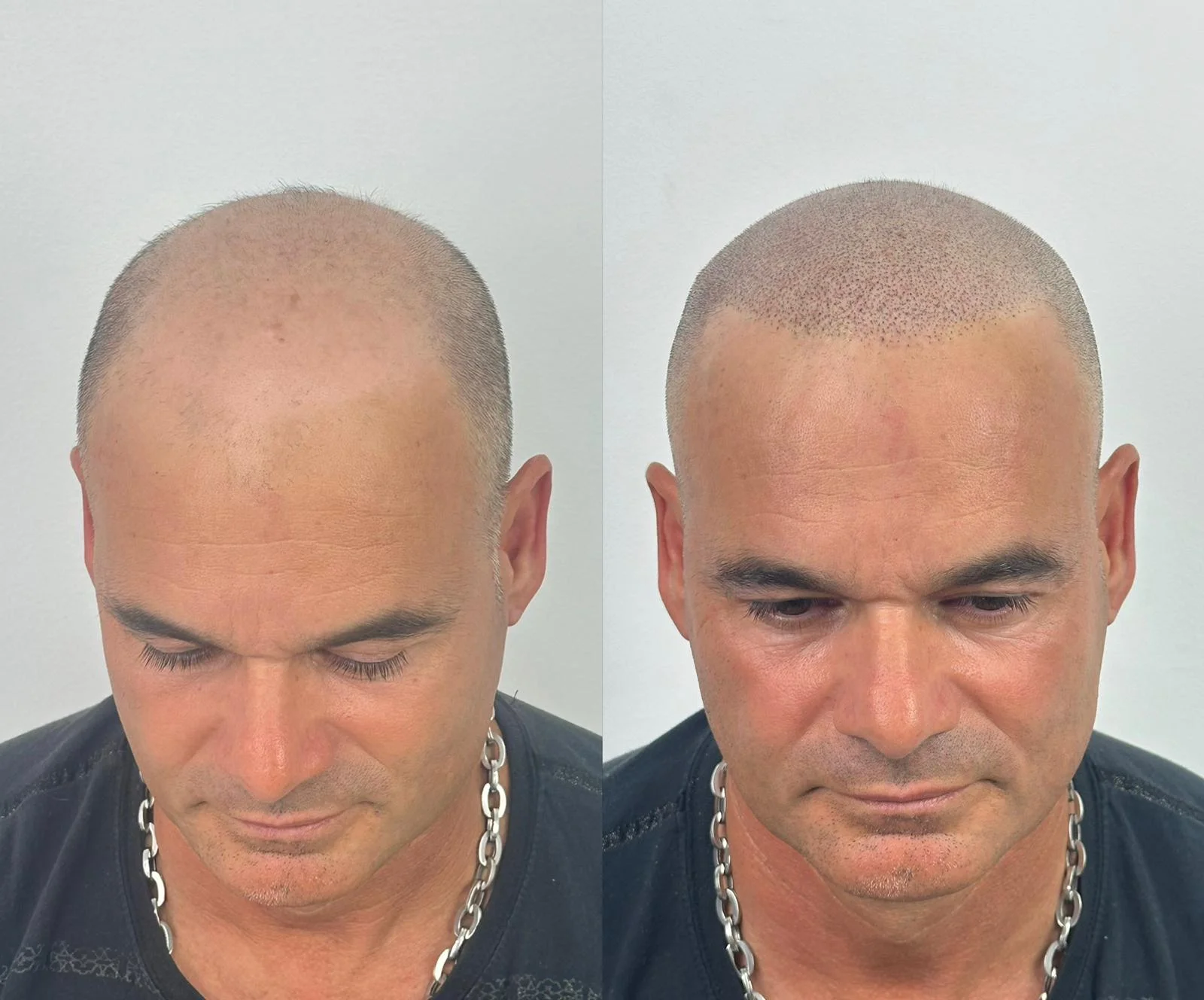 resultado-micropigmentacion-capilar-rapado