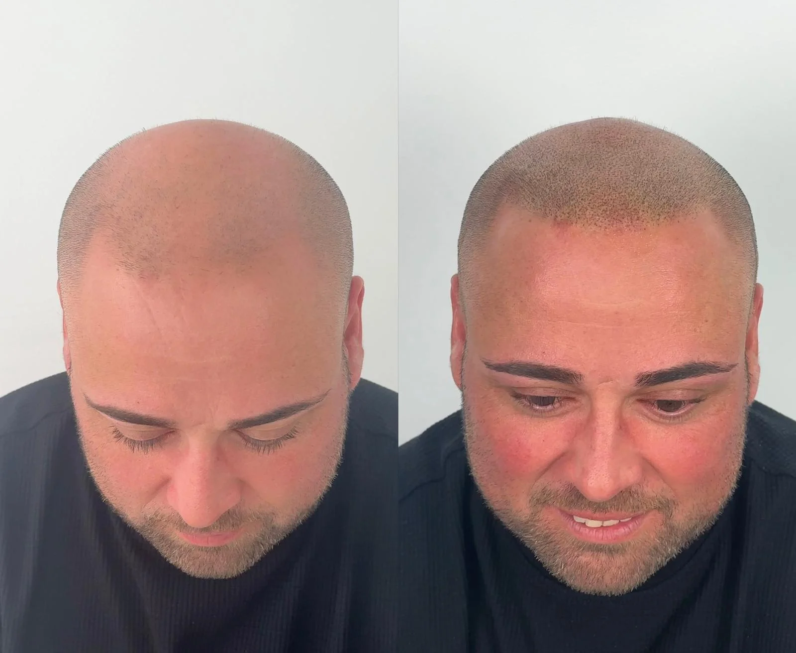 micropigmentacion-capilar-resultados-efecto-rapado