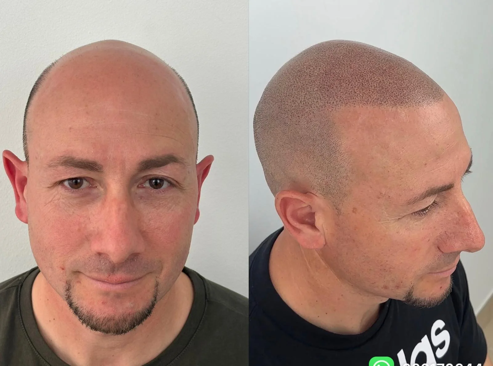efecto-rapado-resultado-micropigmentacion-capilar