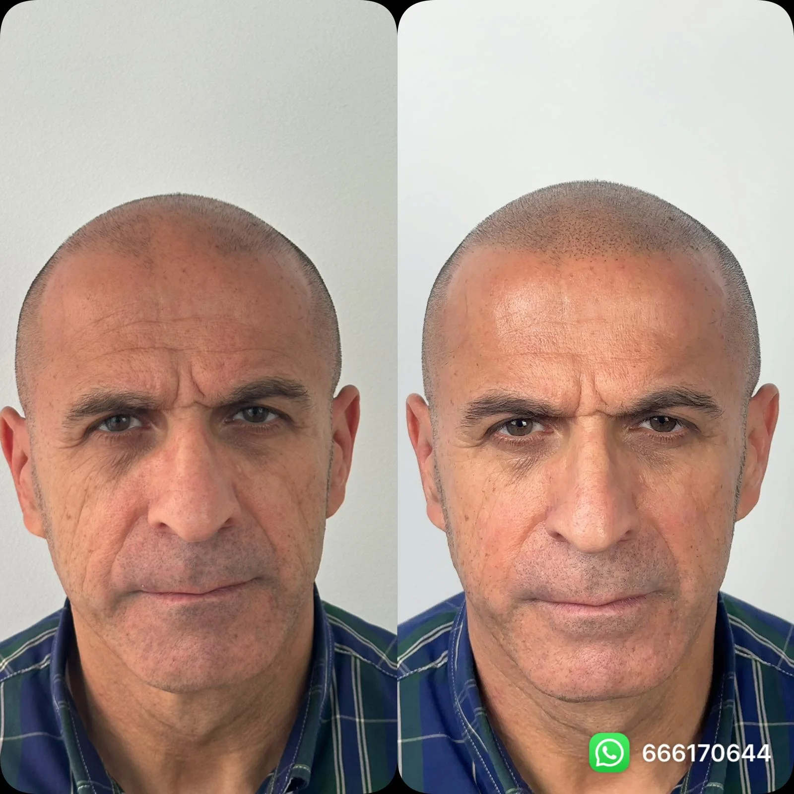 antes-despues-micropigmentacion-capilar-hombres