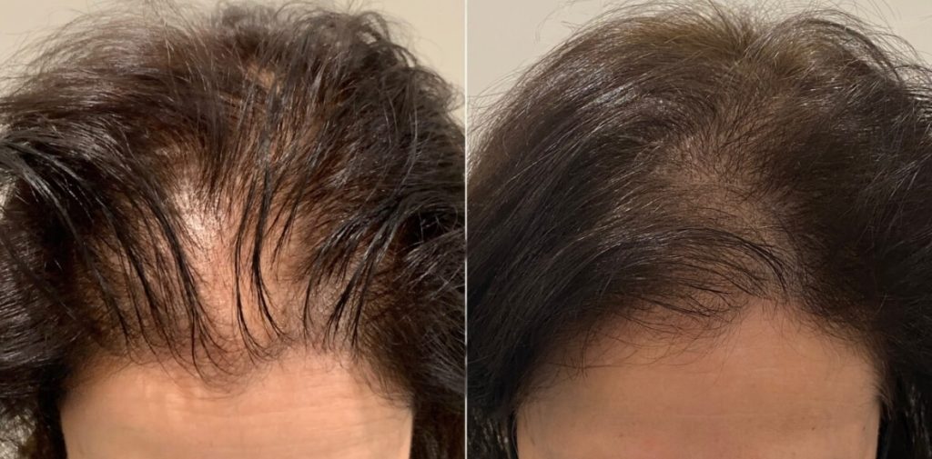 micropigmentacion-mujeres-antes-despues