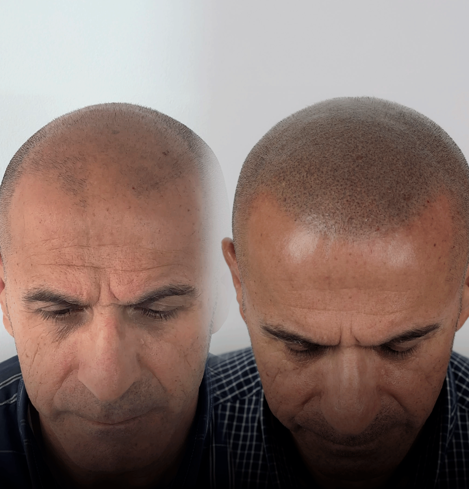 recuperar-autoestima-tras-micropigmentacion-capilar