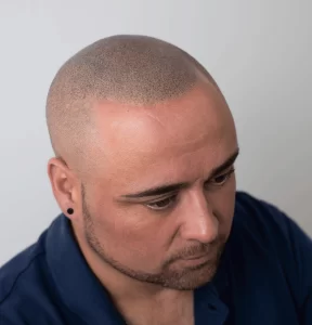 resultados-realistas-micropigmentacion-capilar