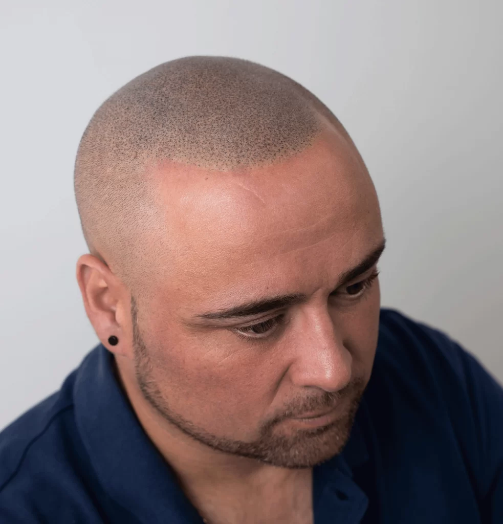 resultados-realistas-micropigmentacion-capilar