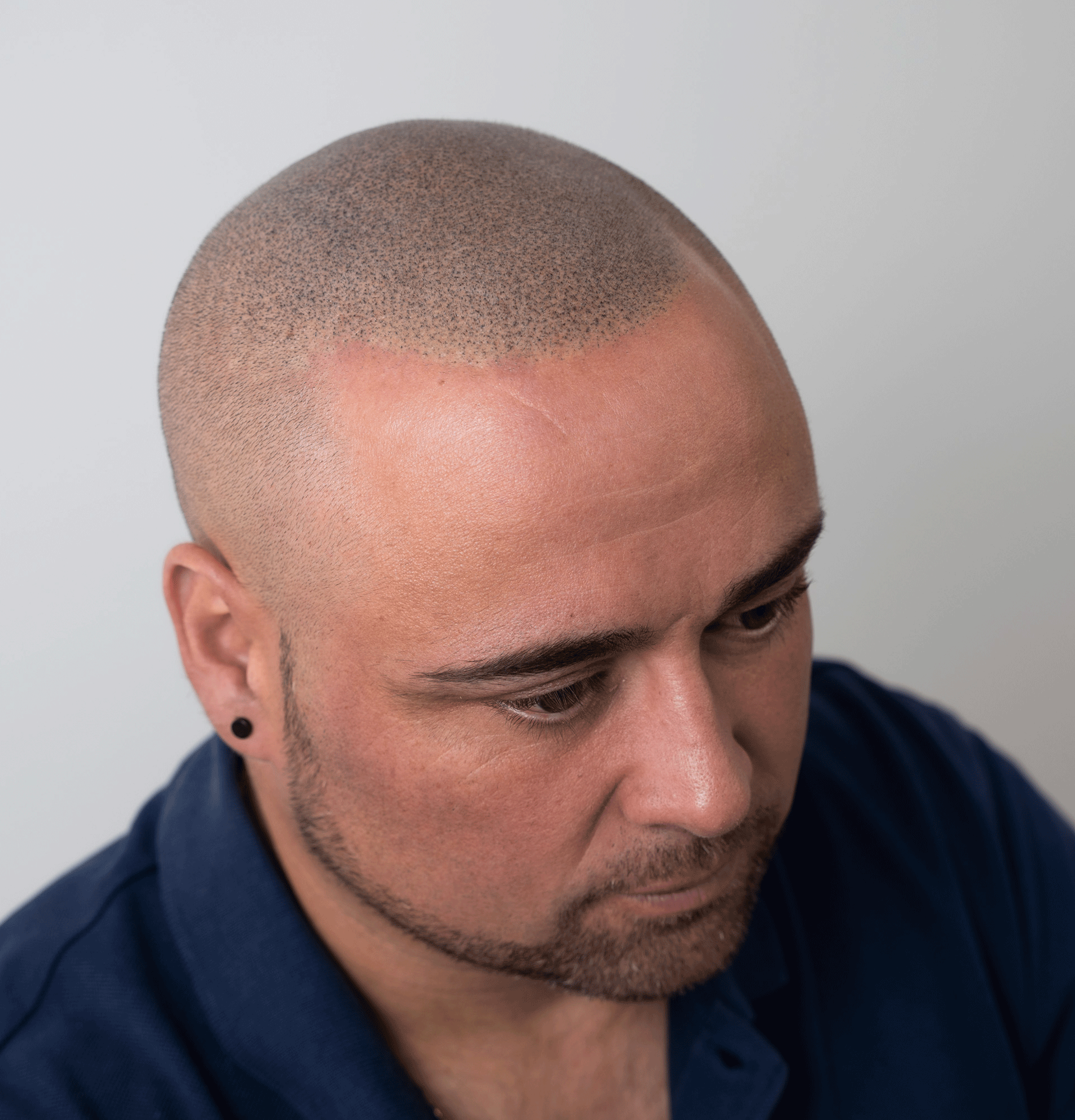 resultados-realistas-micropigmentacion-capilar