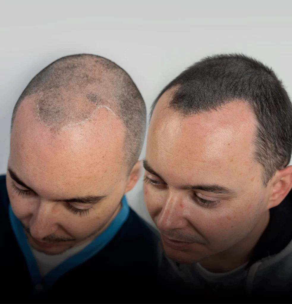 antes-despues-micropigmentacion-capilar