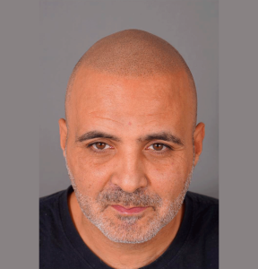 micropigmentacion-capilar-pelo-canas