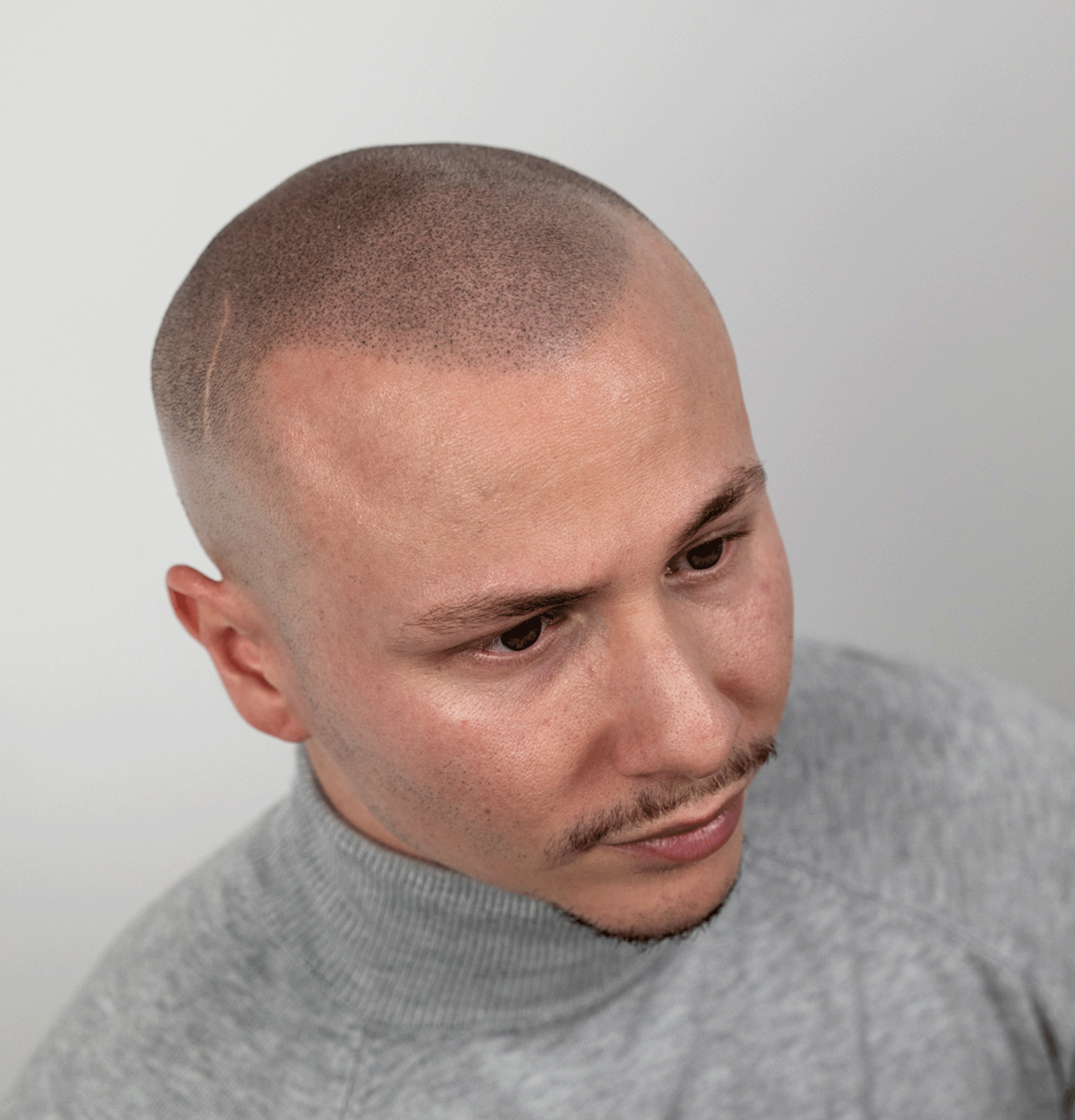 cuidados-antes-despues-micropigmentacion-capilar