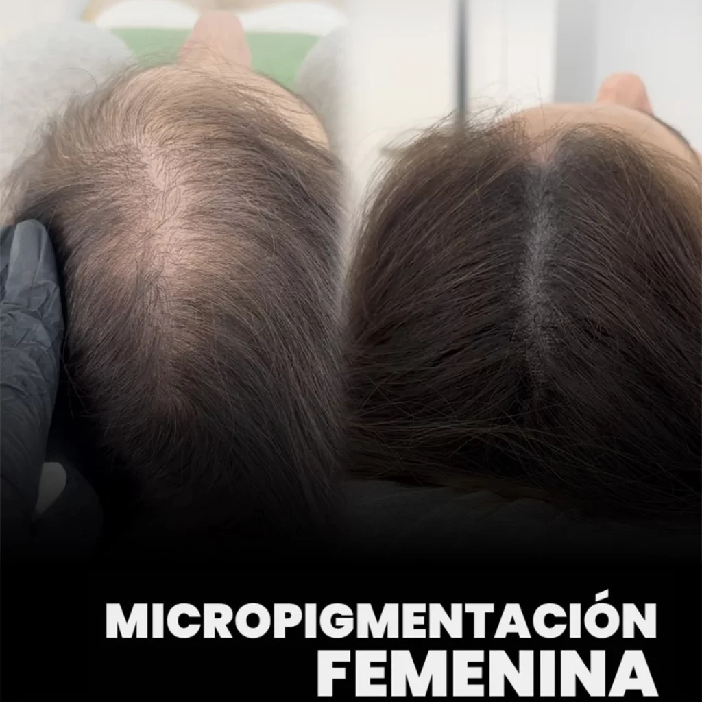 micropigmentacion-en-mujeres-caida-cabello